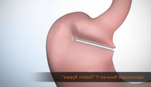 Roux-en-Y Gastric Bypass